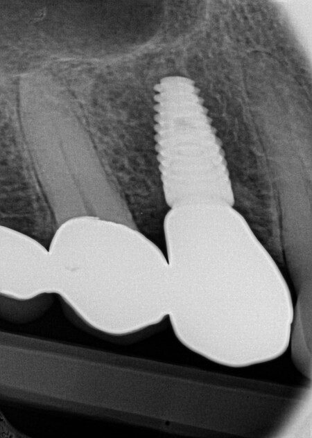 big X ray 5 taken on June 22 23 f4f81bde 88cf 4508 b057 a6fdd5eb0cc6